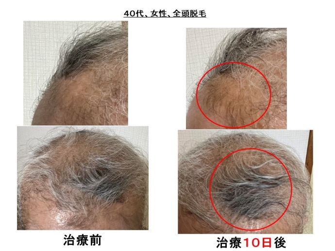 円形脱毛症　病院